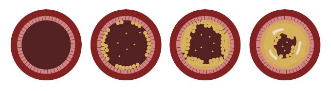 Plan-Accion-Colesterol-Fases-Colesterol_Simple-Blending